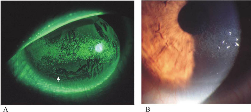 DRY EYE DISEASE (DED)