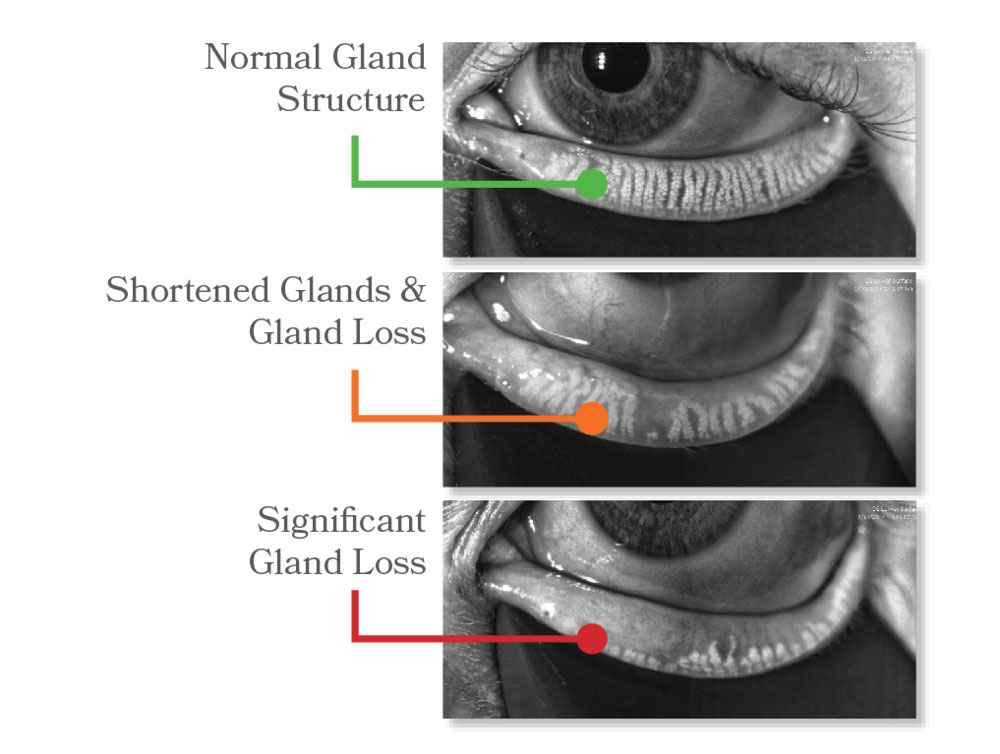 MEIBOMIAN GLAND DYSFUNCTION (MGD)