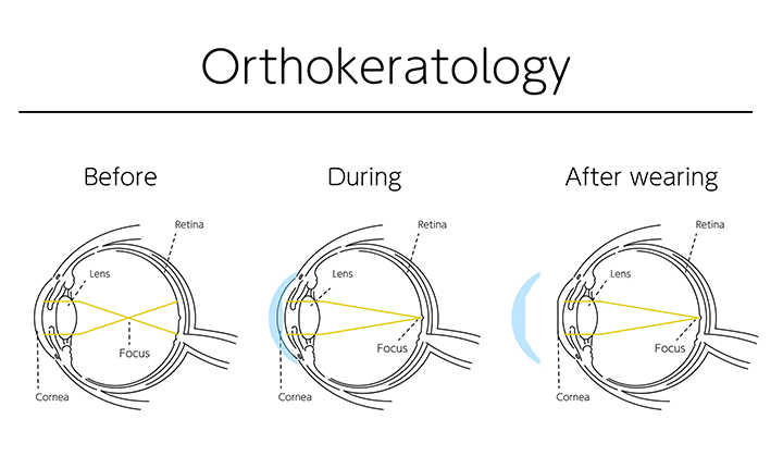 ORTHOKERATOLOGY