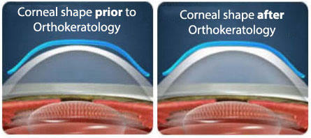 ORTHOKERATOLOGY